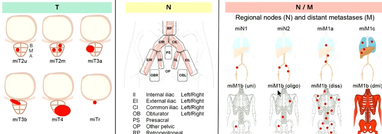 Course5_LifeSci's tweet photo. PSMA PET for Castration-Resistant Prostate Cancer - How Far Have We Come? #EANM21 @officialEANM 
Molecular imaging TNM classification for the whole-body staging of #prostatecancer https://t.co/malCocFGGD