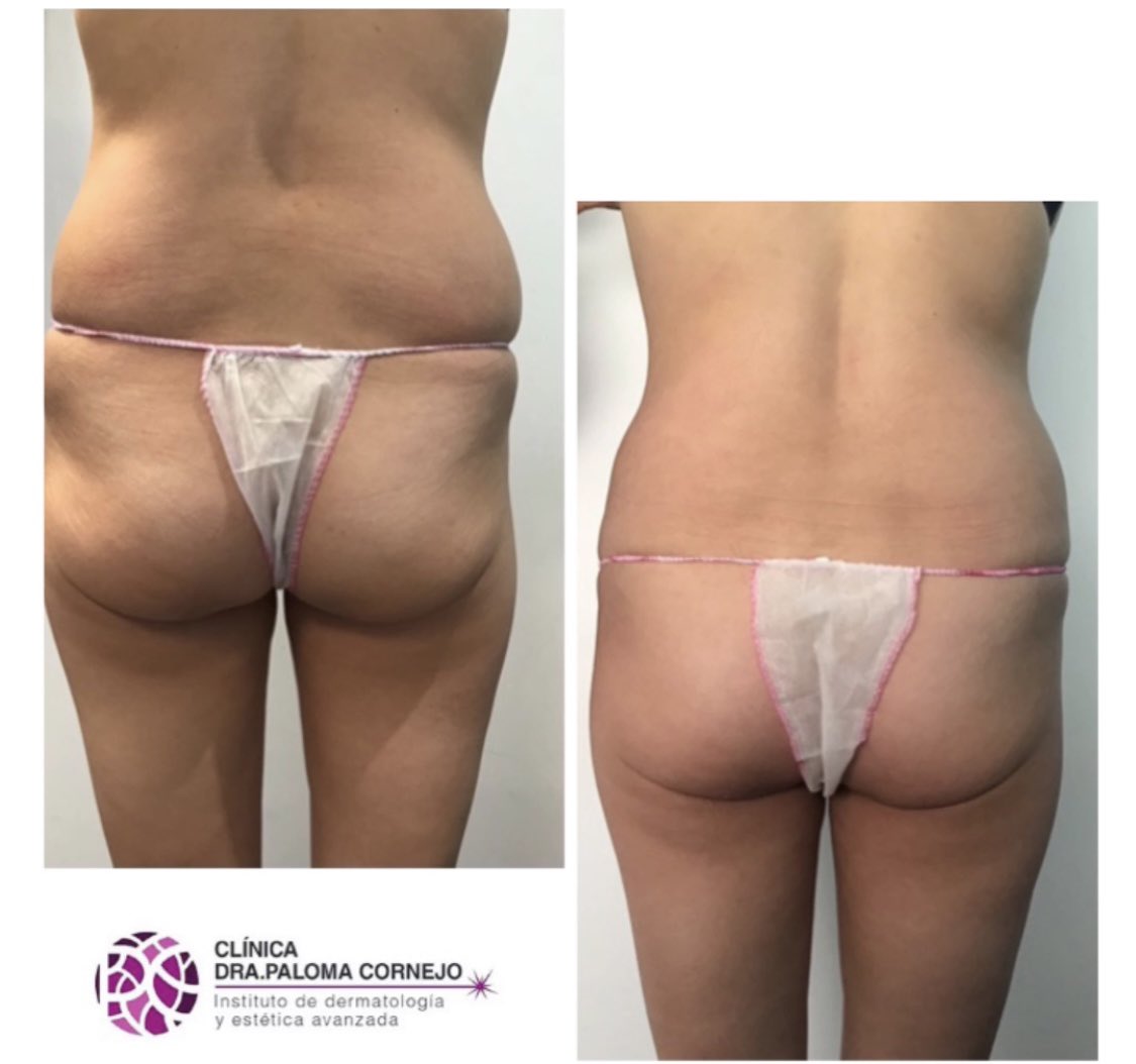DoctoraLaser's tweet photo. En solo 1️⃣sesión de #Criolipolisis hemos conseguido rebajar el panículo graso d los costados o #flancos d esta paciente Post completo 👉🏻 https://t.co/dHK7XZCmUi

#grasalocalizada #flacidezcutanea #grasaabdomen #celulitismadrid #criolipolisismadrid #doctoraláser #dermatologomadrid https://t.co/bVsiyxBAaw