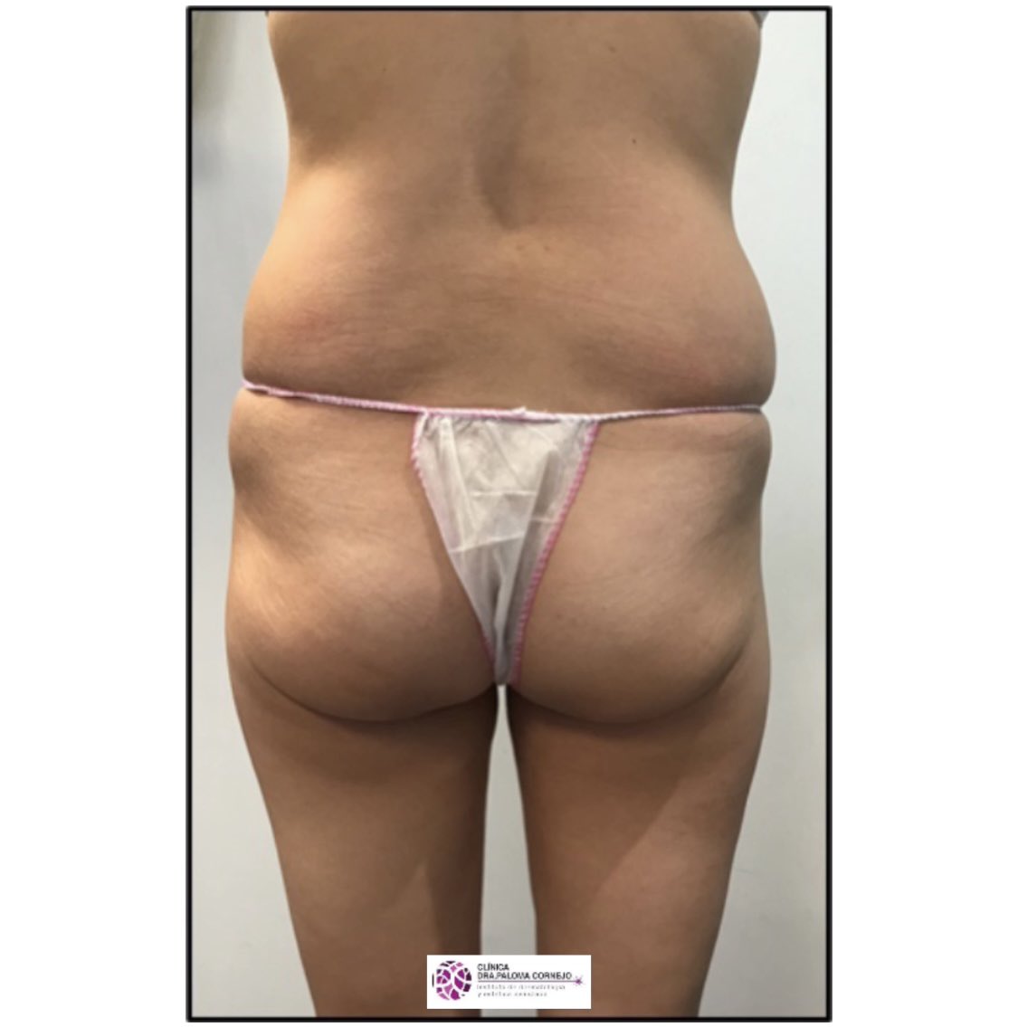 DoctoraLaser's tweet photo. En solo 1️⃣sesión de #Criolipolisis hemos conseguido rebajar el panículo graso d los costados o #flancos d esta paciente Post completo 👉🏻 https://t.co/dHK7XZCmUi

#grasalocalizada #flacidezcutanea #grasaabdomen #celulitismadrid #criolipolisismadrid #doctoraláser #dermatologomadrid https://t.co/bVsiyxBAaw