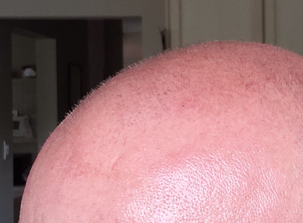 Rich_Cooper's tweet photo. My buddy @JayCampbell333 sent me new peptide products for hair regrowth & skin health he wanted me to try.
My luscious mane is far from back & I even used primobolin this summer (aka the hair follicle killer) on top of TRT, but I was still surprised with the before/after. https://t.co/UjCrtU8gRR