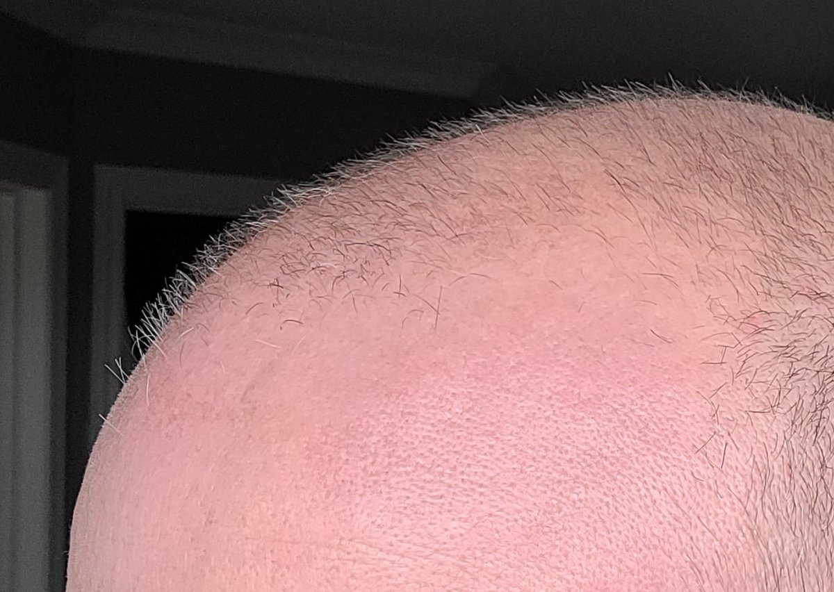 Rich_Cooper's tweet photo. My buddy @JayCampbell333 sent me new peptide products for hair regrowth & skin health he wanted me to try.
My luscious mane is far from back & I even used primobolin this summer (aka the hair follicle killer) on top of TRT, but I was still surprised with the before/after. https://t.co/UjCrtU8gRR