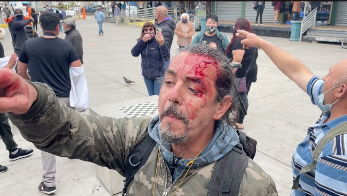 AgenciaQuinta's tweet photo. 🔴Pescadores heridos con balines disparados por La Armada en Valparaíso.
#manifestaciones #protestaschile #protestas #protestaspescadores #pescadoresheridos #laarmada https://t.co/R6C9pPfWLc