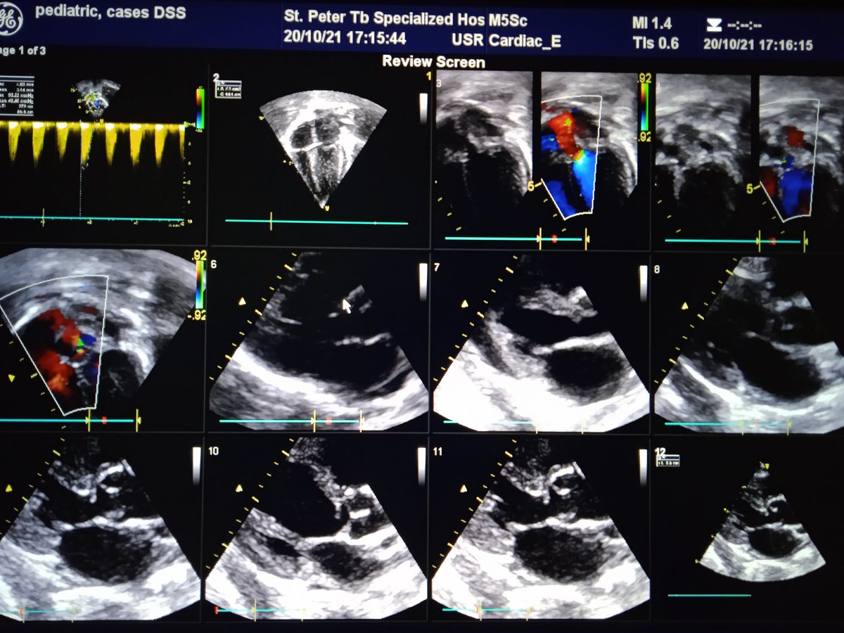 Case of the day. A 4 years old girl moderate growth, presented with cough and SOB, no peripheral edema but wheezing.
Anyone interested to operate her please as she even cant afford to come for clinic visits.<a href="/kfaisalhospital/">King Faisal Hospital Rwanda</a> <a href="/STHBofficial/">Save the Heartbeat</a> <a href="/lia_tadesse/">Lia Tadesse</a> <a href="/dr_zelalem/">🇪🇹ዶ/ር መሠረት ዘላለም Meseret Zelalem (MD)</a>