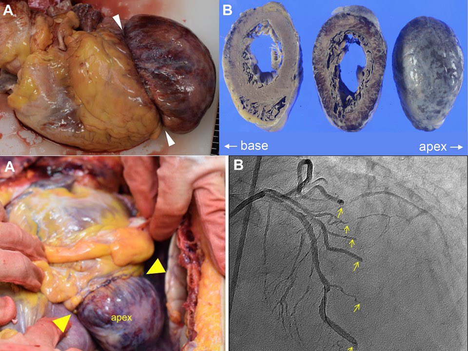 Have you ever seen cardiac strangulation presenting as acute #STEMI? #JACCCaseReports jacc.org/doi/10.1016/j.… <a href="/fischman_david/">David L. Fischman</a> <a href="/mividovich/">Mladen Vidovich</a> <a href="/cardioPCImom/">Ki Park</a> <a href="/mirvatalasnag/">MIЯVΛƬ #IC ༄ ｡°</a> <a href="/dr_benoy_n_shah/">Benoy Shah MD</a> <a href="/achdoctmoe/">Tabitha Moe MD, FACC</a> <a href="/argulian/">Edgar Argulian</a> <a href="/rafavidalperez/">rafavidalperez</a> <a href="/BakhshiHooman/">Hooman Bakhshi</a> <a href="/IndahSP_MD/">Indah Sukmawati, MD</a> <a href="/sarano_maurice/">Maurice Sarano</a>