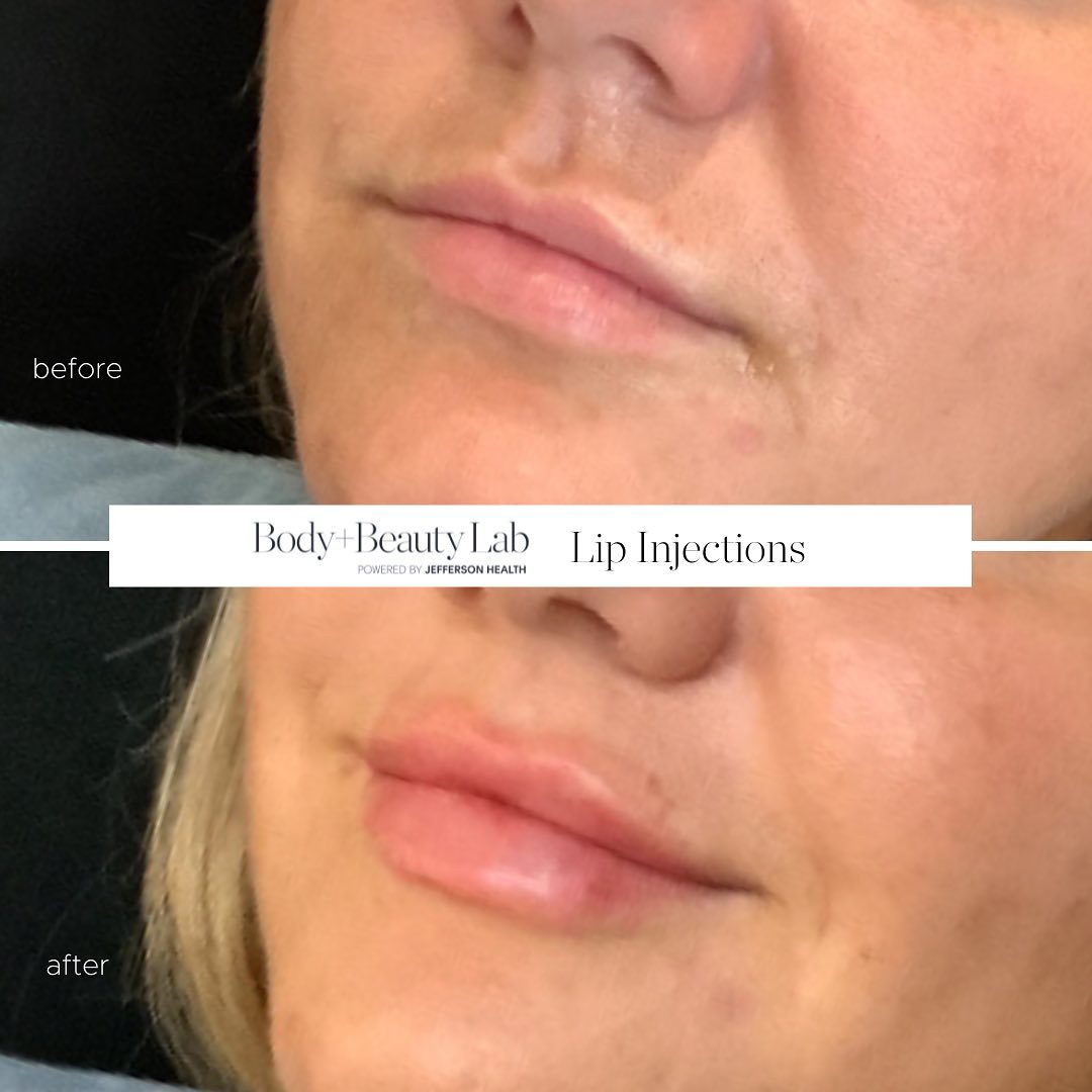BodyBeautyLab's tweet photo. 💋 Lip Injections at bodyandbeautylab 
👩🏻‍⚕️ Treatment performed by Medical Injector Lisa DiLello RN injectionista_lisa 
📞 Call to schedule Philly (215)989-3500 or Radnor (484)254-4099 https://t.co/IblRRqQDXF