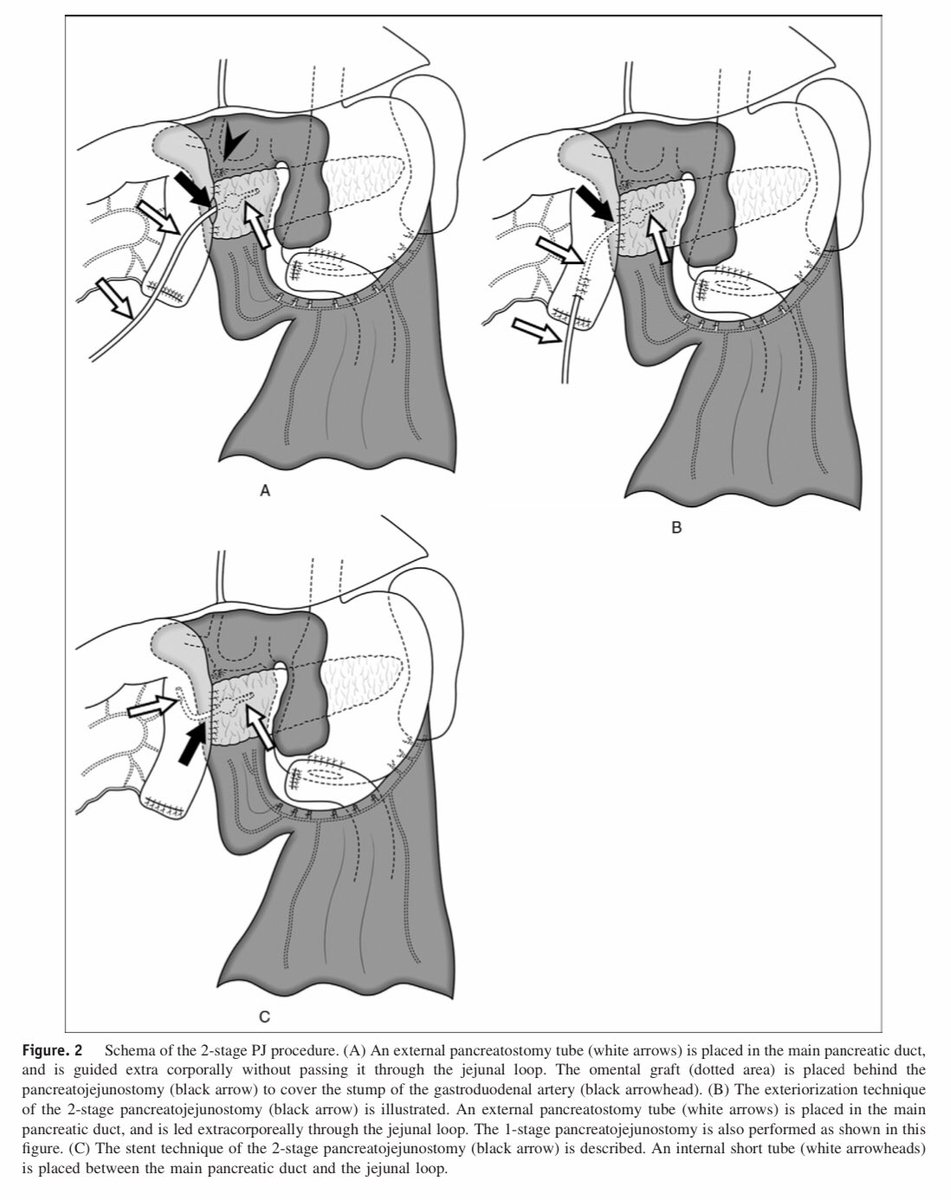 #SurgicalTBT Two-stage 🆚 One-Stage pancreatojejunostomy in pancreaticoduodenectomy 👁🎬 💥🔪🚩⤵️! #SoMe4Surgery <a href="/herbchen/">herb chen</a> <a href="/pferrada1/">Paula Ferrada MD FACS FCCM MAMSE</a> <a href="/PipeCabreraV/">Dr Luis Felipe Cabrera Vargas MD FACS</a> @cirbosque <a href="/SocietyofBAS/">Society of Black Academic Surgeons</a> <a href="/DChu80/">Daniel I-Hsin Chu | 朱以信</a> <a href="/SWexner/">Steven D Wexner MD, PhD</a> <a href="/juliomayol/">Julio Mayol</a> @MISIRG1 <a href="/JBMatthews/">Jeff Matthews MD</a> <a href="/DanaTelem/">Dana Telem</a> <a href="/pturnermd/">Patricia L. Turner, MD, MBA, FACS</a>