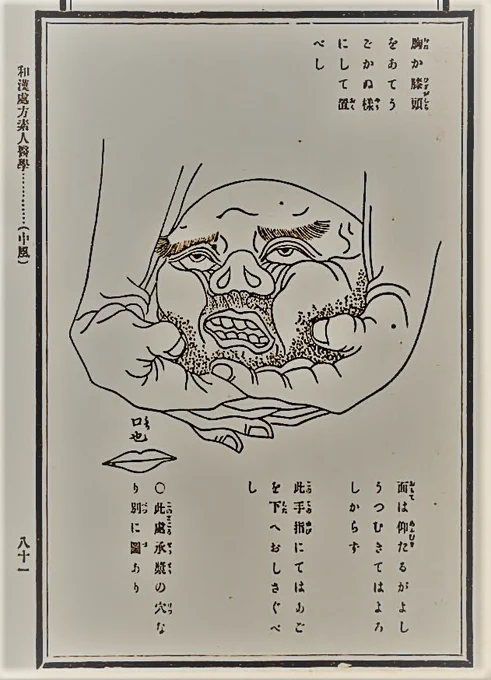 大正時代の医学本の図から。右のは回復して朗らかな表情になったTさん。 