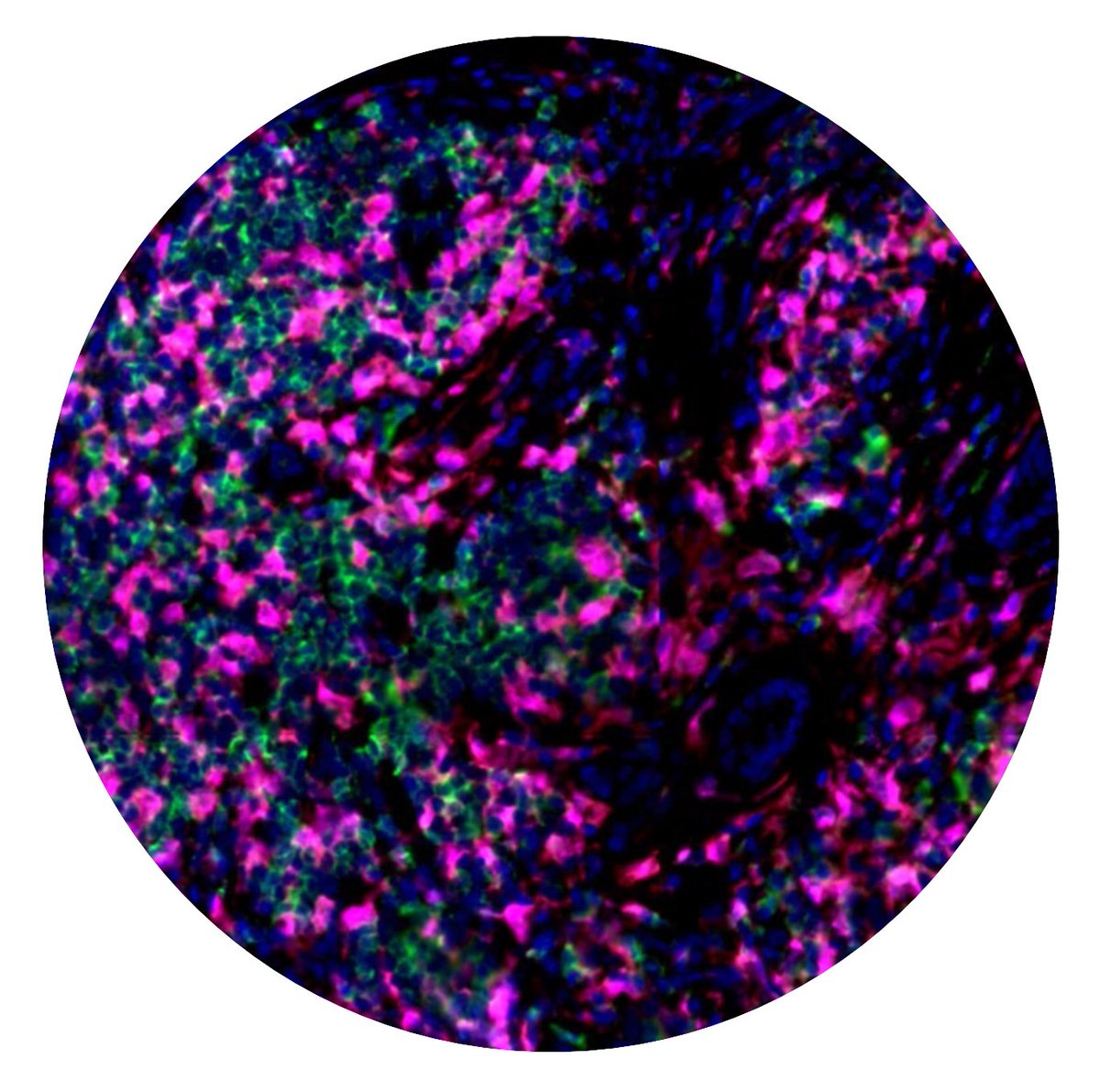 RheumJnl's tweet photo. Two very different images in today’s match-up!
1⃣Immunoflourescence shows MerTK (magenta) and ProS1 (green) https://t.co/MD4zn5TiU6 by Rovati et al #IgG4
🆚
2⃣X-ray shows Eagle syndrome https://t.co/TBNzyD64ay by @CHATTERJEEARGHY @joysamanta et al #rheumatoidarthritis
#RheumOff https://t.co/e2feGa5bbV
