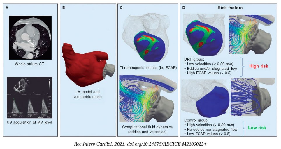 UPFBarcelona's tweet photo. #RecercaUPF 🫀👩💻🧑🏫
Les simulacions de flux sanguini poden millorar el seguiment de la fibril·lació auricular.
Recerca feta per un equip de @BCN_MedTech #UPFBarcelona, l'@HospitalSantPau i l'@hospitalclinic.
👉 https://t.co/slm8KkPHBw https://t.co/KAjjUVgWq1