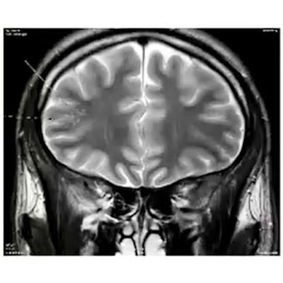 AuntMinnieEuro's tweet photo. Artificial intelligence and #fMRI will produce more specific diagnoses in a wide range of psychiatric disorders that are notoriously difficult to diagnose, leading to more personalized therapy, say French experts. https://t.co/kBjFwrnb5M #Neurospin #radiology #JFR #BrainImaging https://t.co/DVdyqaK9Iv