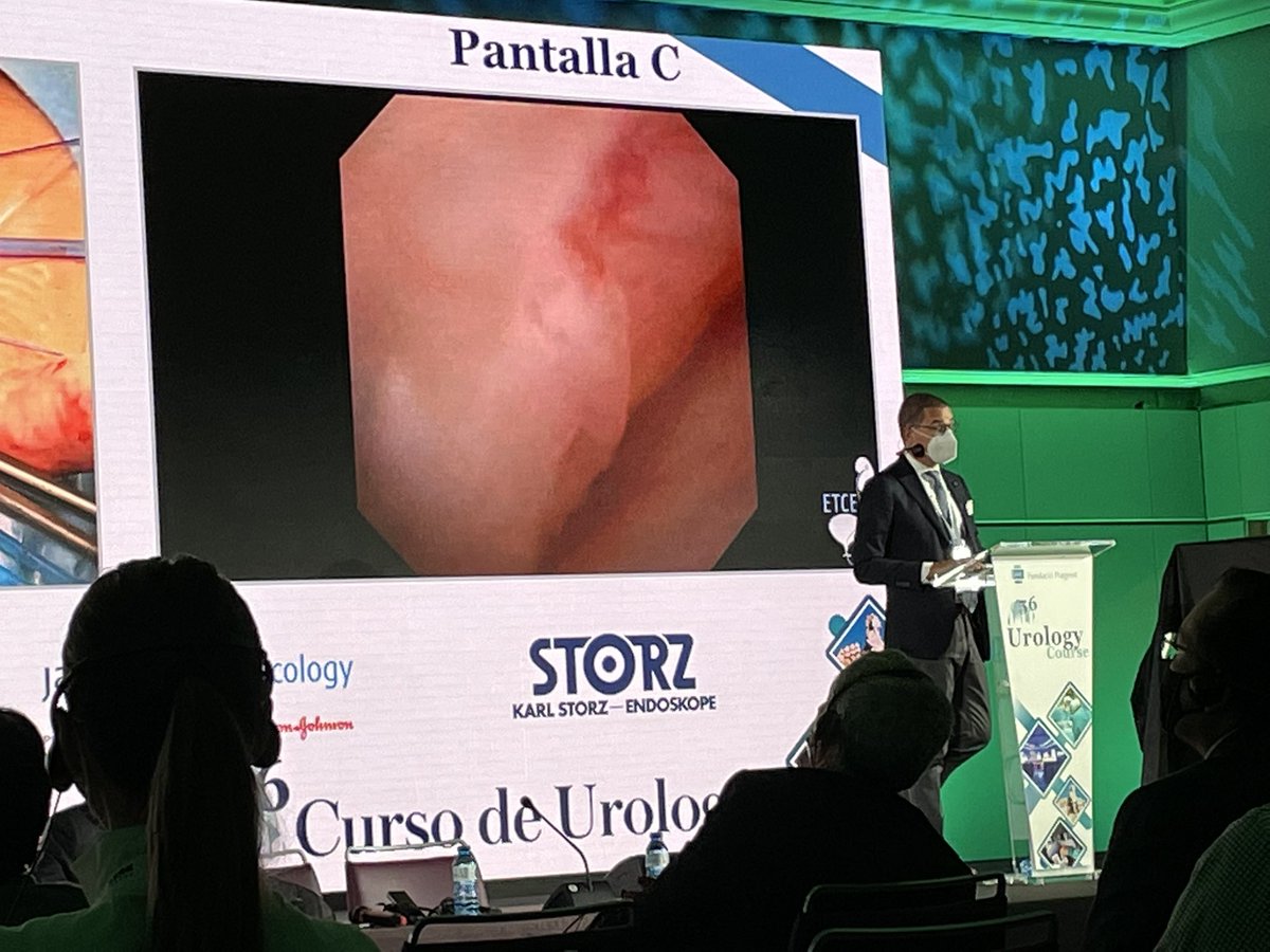 “In endourology, the limit between a masterpiece and a nightmare is really thin” Prof. <a href="/GuidoGiusti/">Guido Giusti</a> Brilliant endoscopic treatment upper calix UTUC tumor. Day 2 <a href="/FPuigvert/">Fundació Puigvert Barcelona</a> #56UroPuigvert