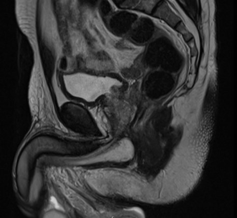 Active surveillance for prostate cancer: missing the boat

These demanding endourology cases will give any urologist nightmares. Tap the link to read the article > bit.ly/30xfF2R