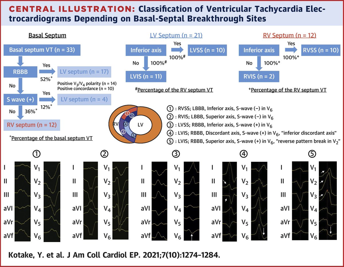 JACCJournals's tweet photo. In patients with structural heart disease, the basal septum is a common source of ventricular #tachycardia (VT). 

Read this elegant review of both the clinical and electrophysiological characteristics of VT from this area: https://t.co/BA9uW3oaDC

#JACCCEP #HeartDisease #EPeeps https://t.co/1FiZ9orFWC