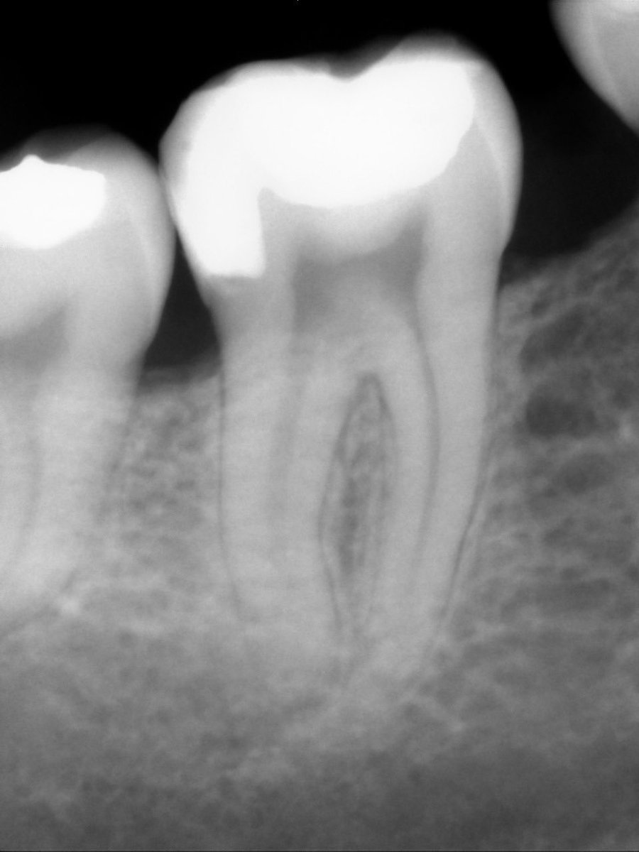 Class ll composite on tooth #31. 
'
It was very challenging experience for me, but finally I’m so satisfied with the result 😍. 
'
Big thanks to Dr.<a href="/KSAlmulhim/">Khalid Almulhim</a>!
 I learned a lot today!