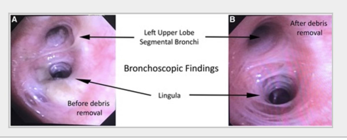 SixandLaura's tweet photo. Vaping-Associated Respiratory Distress Syndrome:Case Classification & Clinical Guidance
February 2020
lower zone opacities…covered w/ opaque necrotic material…removed by suction
#VARDS #EVALI #pathology #broncoscopy #pulmpath #Pathtwitter #pathologist
https://t.co/GGlc7CcuLV https://t.co/ho8qaJ4IQ8