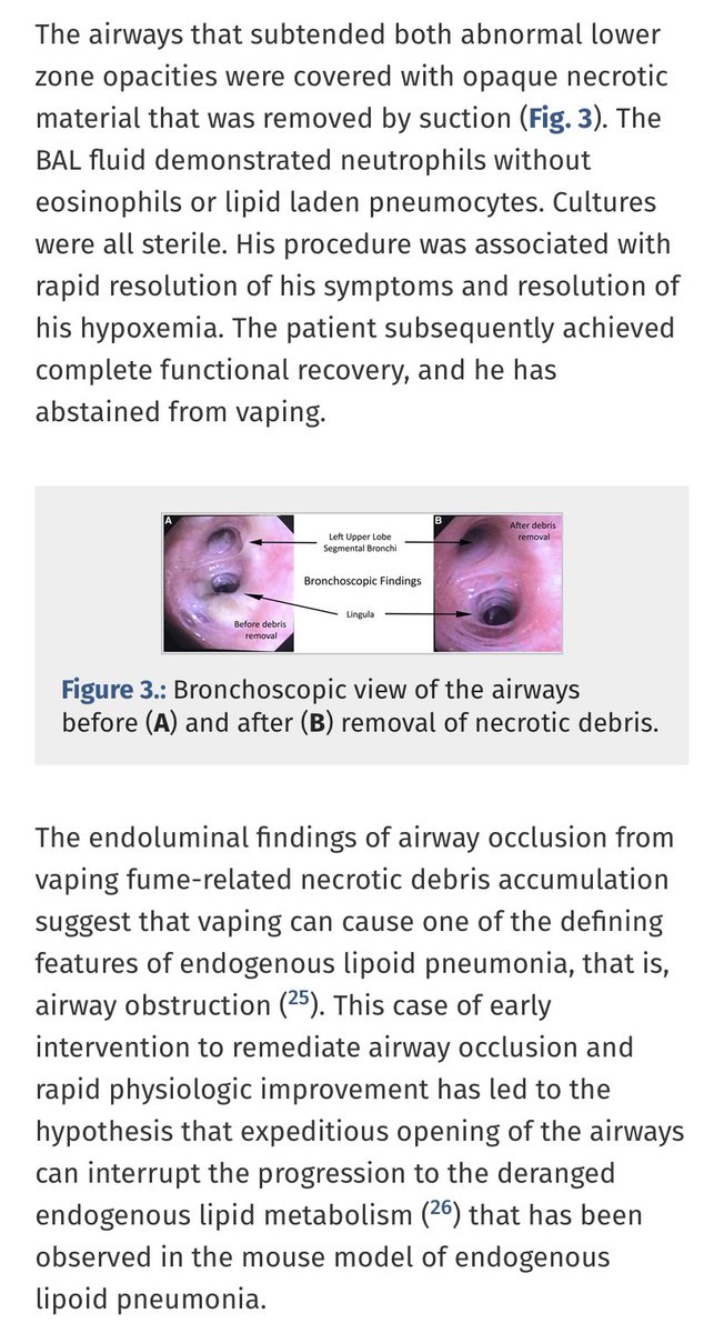 SixandLaura's tweet photo. Vaping-Associated Respiratory Distress Syndrome:Case Classification & Clinical Guidance
February 2020
lower zone opacities…covered w/ opaque necrotic material…removed by suction
#VARDS #EVALI #pathology #broncoscopy #pulmpath #Pathtwitter #pathologist
https://t.co/GGlc7CcuLV https://t.co/ho8qaJ4IQ8