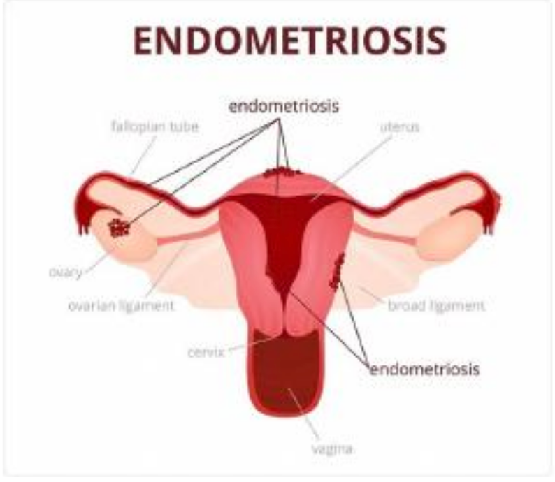 #Endometriosis is most commonly diagnosed around the age of 25 to 40. The most common feature of the condition is heavy and painful #periods. With each #menstrual period, the deposited endometrial tissue is stimulated by #hormones.

#endometriosissupport
#painfulperiod