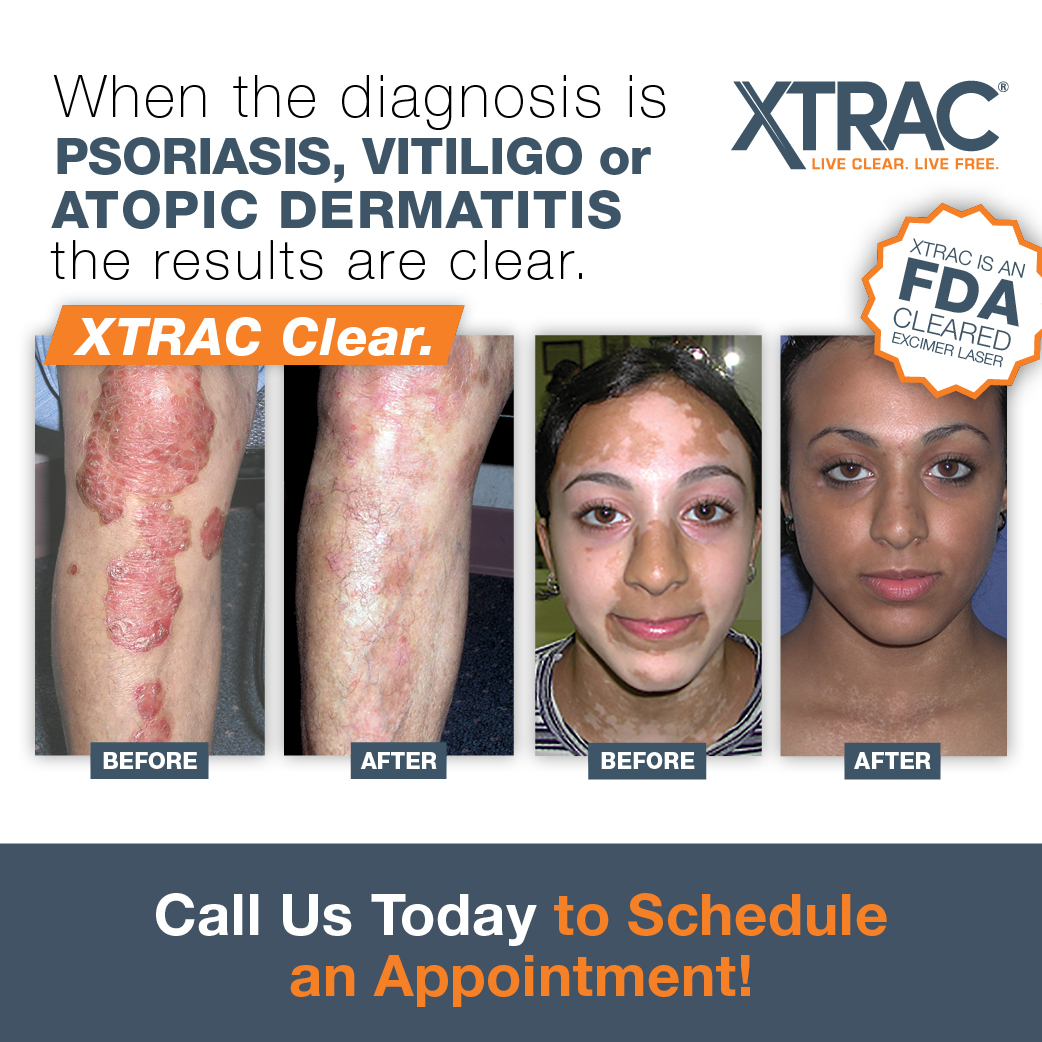 When the diagnosis is Psoriasis, Vitiligo, or Atopic Dermatitis the results are clear.  XTRAC CLEAR!  Call 800-814-9395 today to learn more about XTRAC and find a dermatologist near you!

#xtrac #psoraisis #psoriasistreatment #vitiligo #vitiligotreatment #atopicdermatitis #skin