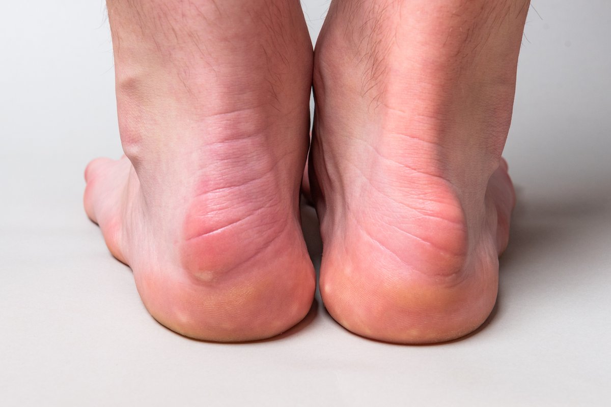 Have you discovered bumps on your heel? Find out what causes them! patelpodiatry.com/blog/bumps-on-…