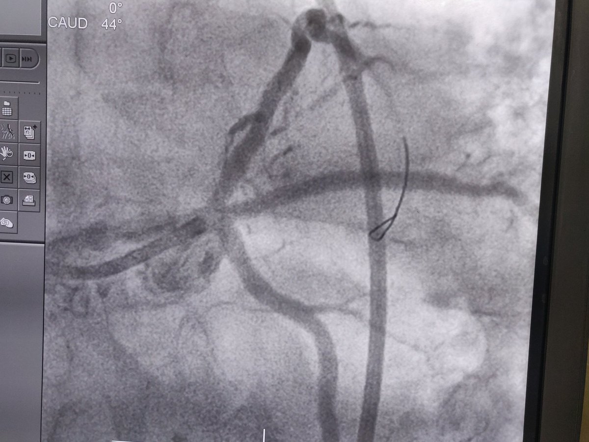 #Vstenting still can be choice of procedure in very selective anatomy.
67 Male, refractory angina, Left dominant. LAD RI Severe disease. LCX wide angle. LM LAD mismatch.
Successful V-stenting of LAD-RI.
#PCIcase #InterventionalCardiology