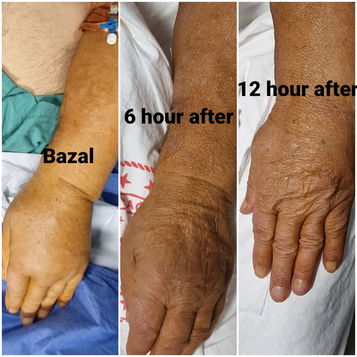 Dialysis + ESRD. Left brachiocephalic trunk total.  severe swelling in the left arm. After PTA and stent, the swelling resolved within 48 hours.  After the procedure, edema fluid is drawn to the center.  Don't forget to take dialysis to avoid pulmonary edema. #dialysis #stent