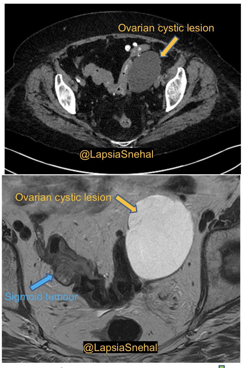 LapsiaSnehal's tweet photo. Satisfaction of search !!! It is easy to get distracted by the obvious ovarian mass. Also appreciate the better soft tissue resolution of MRI!! Thanks to @Sophiechesh for the case. 
#FOAMrad #FOAMed #radres #futureradres #obygyn #surgery #MedTwitter #MedStudentTwitter https://t.co/FKUkJQ9rRy
