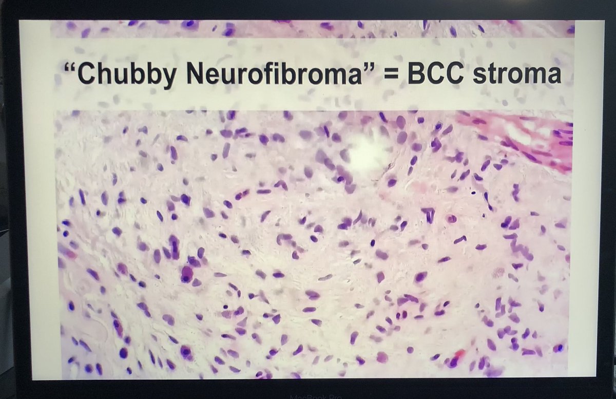 Dermpathl's tweet photo. If you see what looks like a “chubby neurofibroma” get deepers to uncover basal cell carcinoma aggregates. From Dr Subtil’s presentation today at #ASDP21 #dermpath https://t.co/yrPh2R6nU1