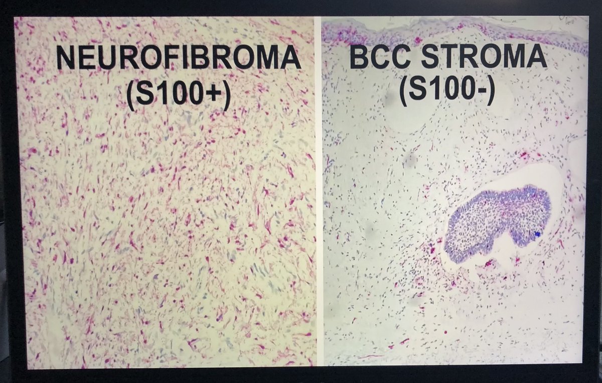Dermpathl's tweet photo. If you see what looks like a “chubby neurofibroma” get deepers to uncover basal cell carcinoma aggregates. From Dr Subtil’s presentation today at #ASDP21 #dermpath https://t.co/yrPh2R6nU1