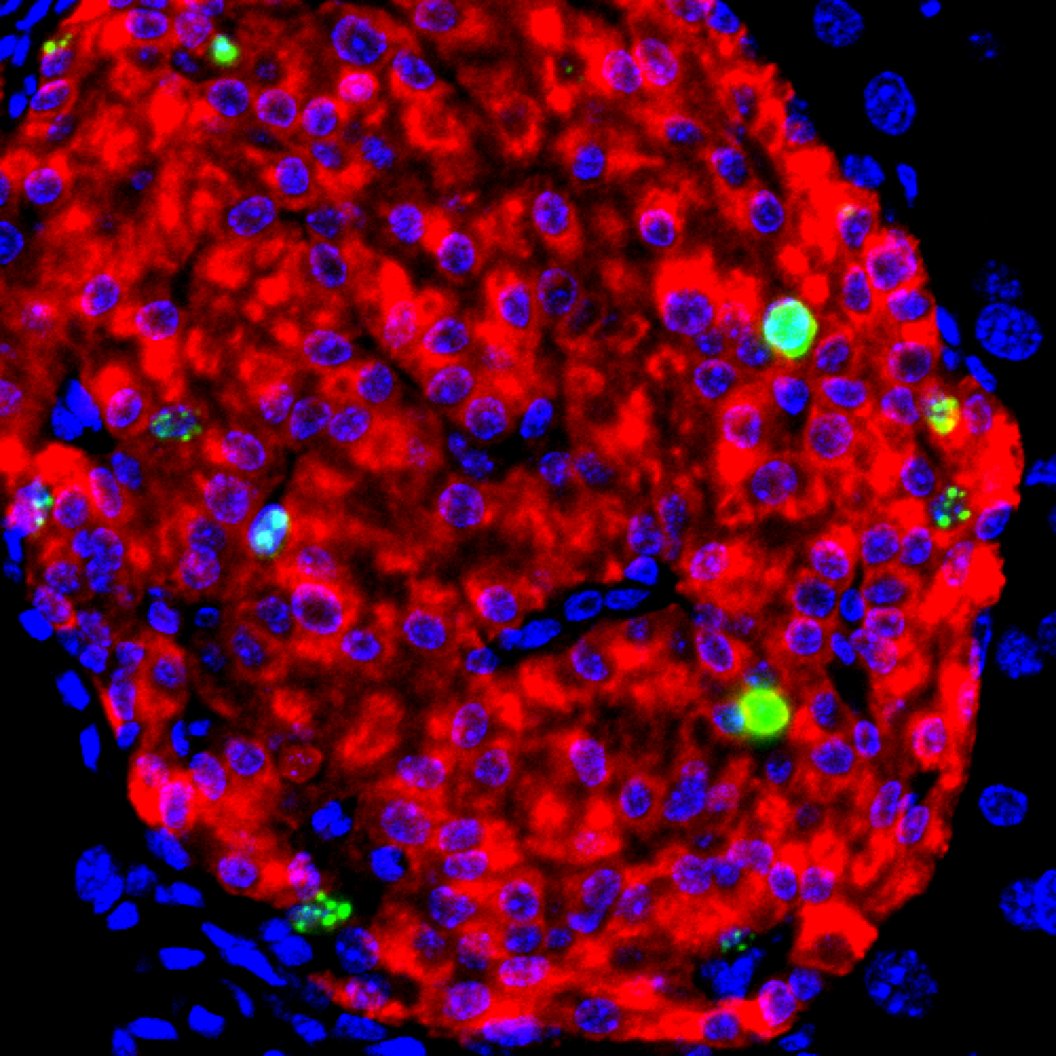 Promising early results show that longstanding research from <a href="/TheMeltonLab/">The Melton Lab</a> may have paved the way for a breakthrough treatment of Type 1 diabetes. Read more about this potentially life-changing therapy here bit.ly/3ncSmDb