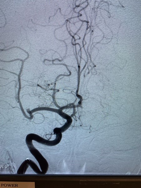 PenNeuro's tweet image. US HCPs: Recanalization with #RED68 by @yafellserulle out of @NorthwellHealth. #RaisingTheStandard #REDglideDifference Rx only. For indications, contraindications, warnings, precautions &amp;amp; potential adverse events see bit.ly/2BYj7Yj Clinical results vary.