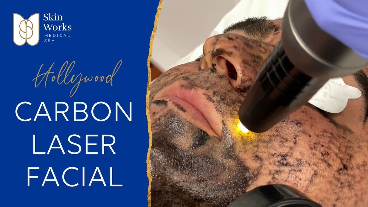 skinworksmedspa's tweet photo. Carbon Laser Facial
https://t.co/EPXyiHEw8h
#hollywoodfacial #carbonpeellaser #carbonpeeling #hollywoodcarbonpeel #skinresurfacing #laser #lasertattooremoval #lasertech #acne #skintightening #porereduction #clearskin #radiantskin #chinadolfacial #flawlessskin #carbonfacial https://t.co/vGdWKcf82I