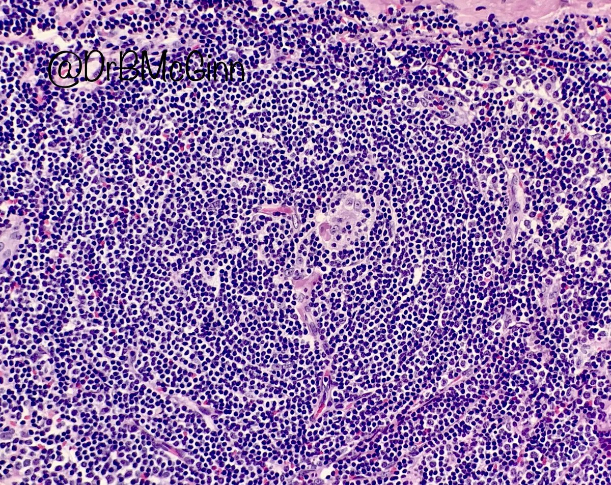 DrBMcGinn's tweet photo. Could I convince anyone this is a penetrating vessel (a “lollipop”) in hyaline vascular Castleman’s disease? #pathology https://t.co/6LQsR2JIPg