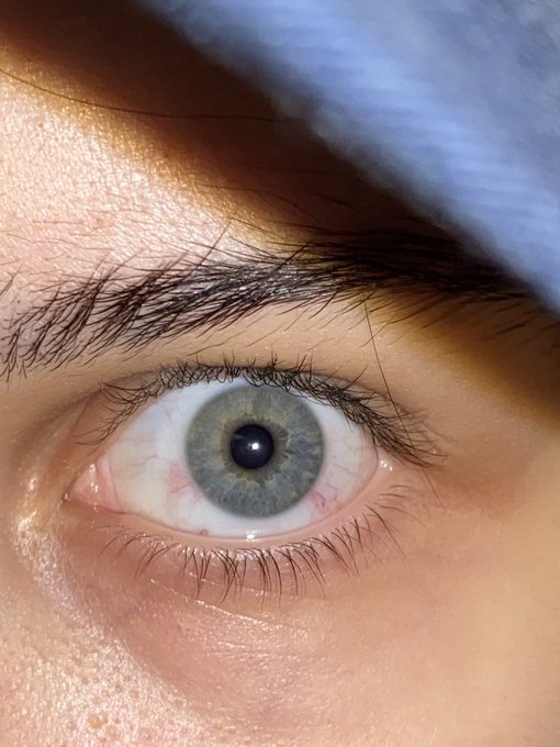 который день лопаются капилляры и почему на фото не так ужасно как в жизни. хотя признаюсь мне даже нравится