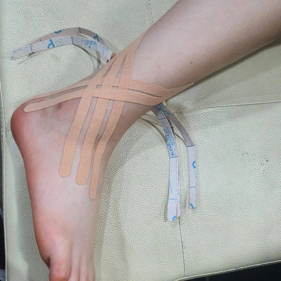 KinesioTape's tweet photo. #Repost @ryusangkyun_
I couldn't even walk, but this is possible
#anklesprain #removeswelling #PainRelief #kinesiotaping #lymphatictaping #jellyfishtaping #x-cut #basketweave
#kinesiouniversity #CKTT #CKTP
#CKTP+ #Ph.D_Ryu #ispykinesiotape
#kinesio #tapewithwisdom https://t.co/Dbw86PjfgA