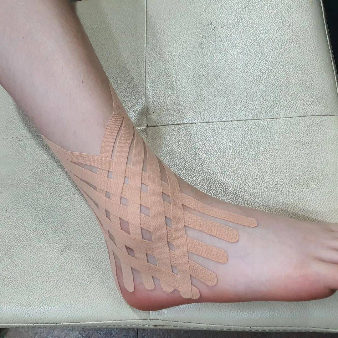 KinesioTape's tweet photo. #Repost @ryusangkyun_
I couldn't even walk, but this is possible
#anklesprain #removeswelling #PainRelief #kinesiotaping #lymphatictaping #jellyfishtaping #x-cut #basketweave
#kinesiouniversity #CKTT #CKTP
#CKTP+ #Ph.D_Ryu #ispykinesiotape
#kinesio #tapewithwisdom https://t.co/Dbw86PjfgA