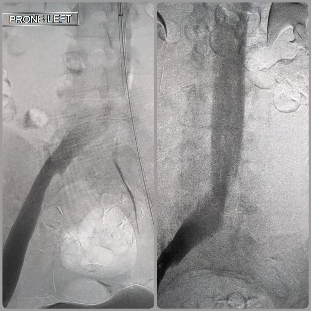 Justin Greene (@greenerads) on Twitter photo Bilateral pop access. 13fr CT sheath contra; 16Fr CT sheath ipsi; 6 clockwise ClotTriever L3-pop. FlowTriever XL disks for proximal embolic protection. Closed with FlowStasis. <a href="/ManuSinghMD/">Manu Singh</a> <a href="/MCW_VIR/">MCW VIR</a> <a href="/InariMedical/">Inari, now part of Stryker</a> <a href="/SIRRFS/">SIR RFS</a>
#clottriever #inarimedical Bilateral pop access. 13fr CT sheath contra; 16Fr CT sheath ipsi; 6 clockwise ClotTriever L3-pop. FlowTriever XL disks for proximal embolic protection. Closed with FlowStasis. <a href="/ManuSinghMD/">Manu Singh</a> <a href="/MCW_VIR/">MCW VIR</a> <a href="/InariMedical/">Inari, now part of Stryker</a> <a href="/SIRRFS/">SIR RFS</a>
#clottriever #inarimedical