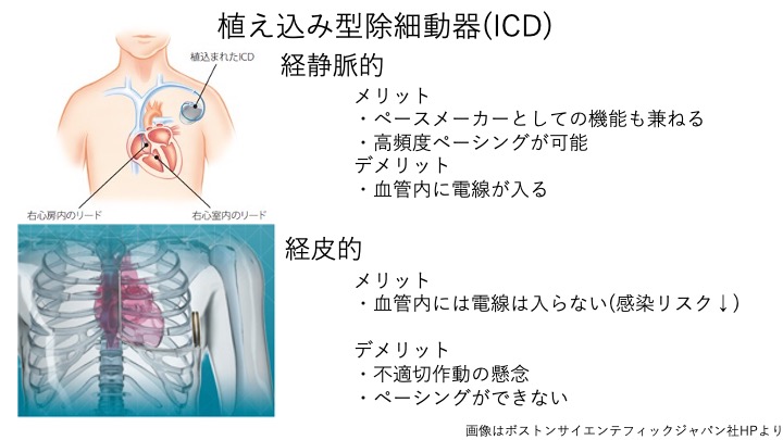 ブルガダ症候群では一定の要件を満たすと、 植え込み型除細動器(ICD)の