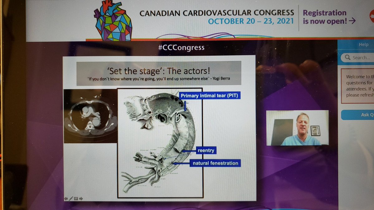 CtacSurg's tweet photo. CTAC surgeon Dr. Dagenais discussing endovascular repair for type B dissection at CCC. Livestreaming now! Please join. https://t.co/b1g0G2MUDr
