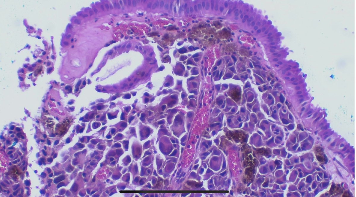 JCandidoXavier's tweet photo. INCREDIBLE! Metastatic melanoma of the gallblader. HE, melanA (magenta)+ki67, AE1/AE3, S100.  
#path #surgpath #pathclues #gipath #dermpath #pathology #patología https://t.co/QRt9XYYiQV