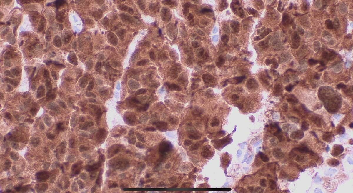INCREDIBLE! Metastatic melanoma of the gallblader. HE, melanA (magenta)+ki67, AE1/AE3, S100.  
#path #surgpath #pathclues #gipath #dermpath #pathology #patología