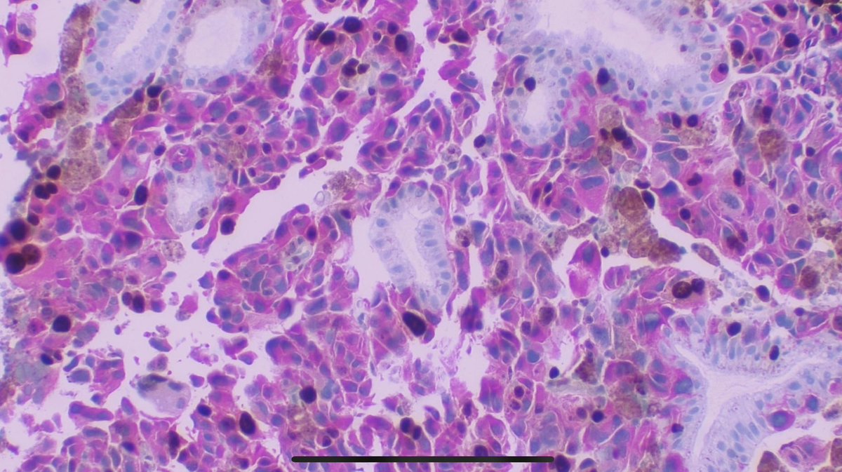 JCandidoXavier's tweet photo. INCREDIBLE! Metastatic melanoma of the gallblader. HE, melanA (magenta)+ki67, AE1/AE3, S100.  
#path #surgpath #pathclues #gipath #dermpath #pathology #patología https://t.co/QRt9XYYiQV