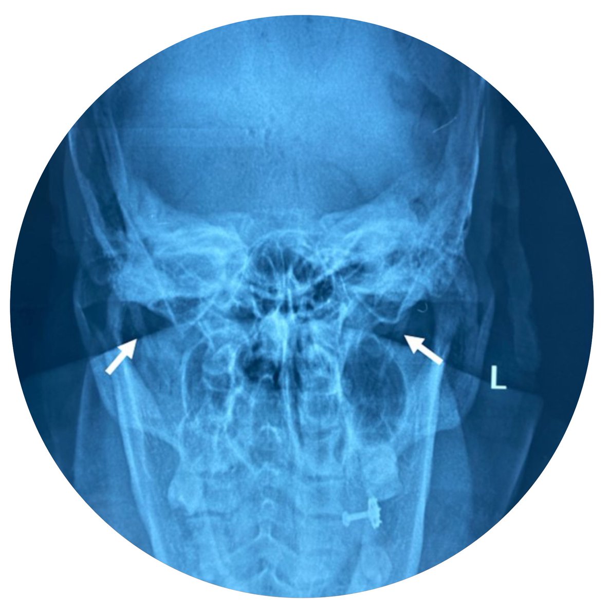 RheumJnl's tweet photo. IT’S THE FINAL! #RheumOff
All I can say is it will be a blue cover!
1Full-body FDG-PET scan of disease activity before TCZ https://t.co/R9CCDZF3Tm by Schönau et al #GCA
Vs
2X-ray of Eagle syndrome https://t.co/TBNzyD64ay by @CHATTERJEEARGHY @joysamanta et al #rheumatoidarthritis https://t.co/qiX3LUwbYw
