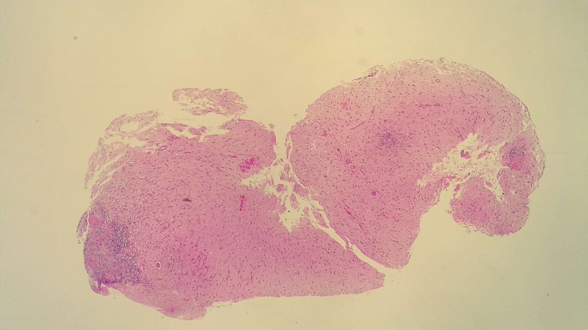 BuddingLiska's tweet photo. Our department's unofficial "case of the year." A brain lesion in a 50 year old immunocompromised female with progressive hemiparesis and headaches. Thank you @AntoiRoets 🐱

@infectiouspatho @Pathoutlines @amjsurgpathol @PathElective @pathtwitter https://t.co/4lHKShe8Xj