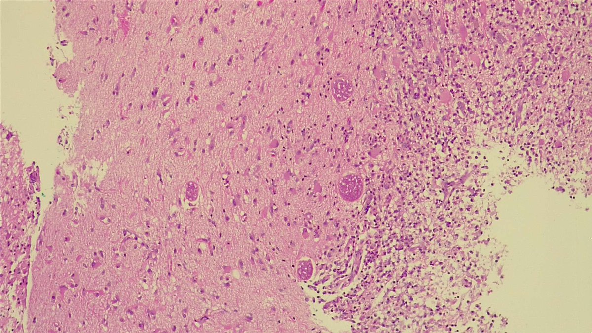BuddingLiska's tweet photo. Our department's unofficial "case of the year." A brain lesion in a 50 year old immunocompromised female with progressive hemiparesis and headaches. Thank you @AntoiRoets 🐱

@infectiouspatho @Pathoutlines @amjsurgpathol @PathElective @pathtwitter https://t.co/4lHKShe8Xj