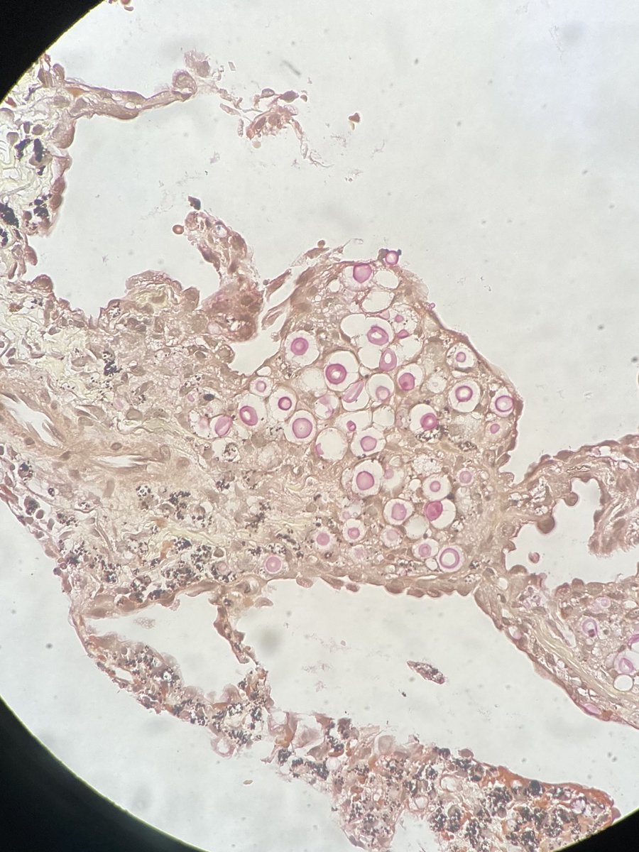 Eli Finkelsztein (@ejfinkel) on Twitter photo Crypto looking stylish 👀 on this mucicarmine stain of lung tissue. Thanks micro and path. <a href="/WCM_ID/">Weill Cornell Infectious Diseases Division</a> <a href="/WCMCPathology/">Weill Cornell Medicine Pathology</a> #MedTwitter #IDtwitter #wcmcmicro Crypto looking stylish 👀 on this mucicarmine stain of lung tissue. Thanks micro and path. <a href="/WCM_ID/">Weill Cornell Infectious Diseases Division</a> <a href="/WCMCPathology/">Weill Cornell Medicine Pathology</a> #MedTwitter #IDtwitter #wcmcmicro