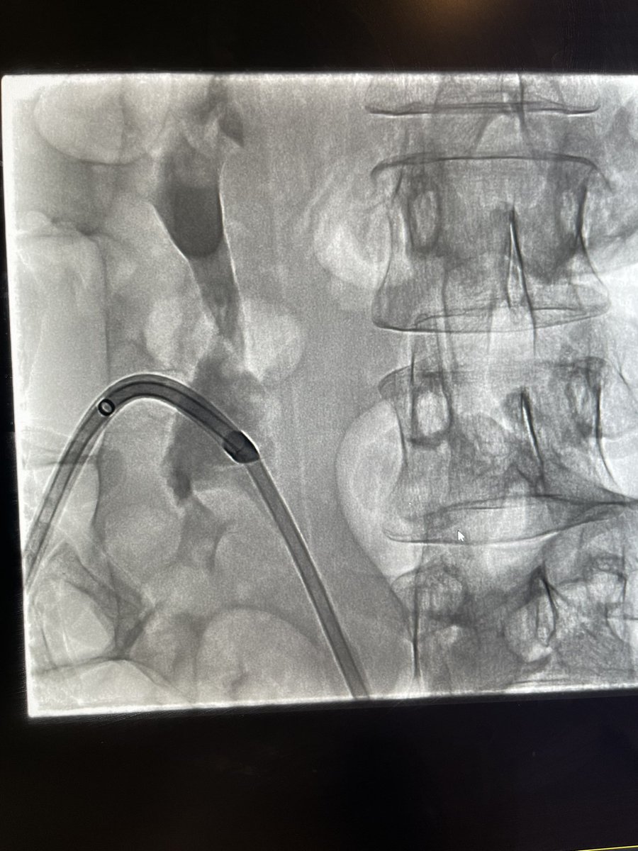 Adeebmsg's tweet photo. Failed retrograde DJ stent removal by colleagues as the bladder was invaded by aggressive tumor.
IR can remove the stent through antegrade approach simply by snare.
((Change course, but don’t give up))
@NGHAnews @AAlkenawi @AzzamKhankan @DrMajedAbdulhaq @dr_algethami @ANGIO_RAD https://t.co/ahFZQsVVIU