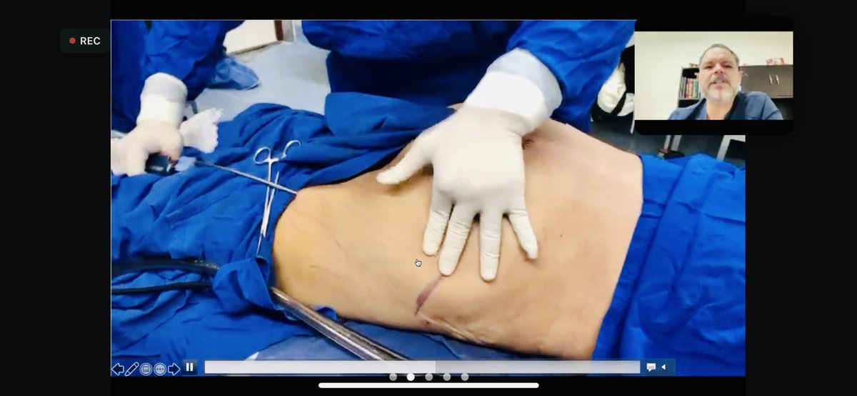 El 𝐃𝐫. 𝐇é𝐜𝐭𝐨𝐫 𝐃𝐮𝐫á𝐧 hablando sobre su experiencia quirúrgica con 𝙸𝙼𝙿𝙻𝙰𝙽𝚃𝙴𝚂 𝙶𝙻𝚄𝚃𝙴𝙾𝚂 𝙷Í𝙱𝚁𝙸𝙳𝙾𝚂 en las 𝕀𝕏 𝕁𝕆ℝℕ𝔸𝔻𝔸𝕊 𝕀ℕ𝕋𝔼ℝℕ𝔸ℂ𝕀𝕆ℕ𝔸𝕃𝔼𝕊 𝔻𝔼 ℂ𝕀ℝ𝕌𝔾Í𝔸 ℙ𝕃Á𝕊𝕋𝕀ℂ𝔸 <a href="/Secpre_Guayas/">SECPRE_Guayas</a> 

#cirujanosplasticos #Guayaquil