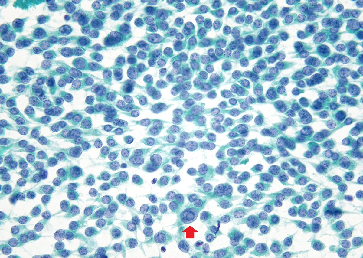 sza_jhcyto's tweet photo. If you think THYROID  Cytology is easy ...
Left - Medullary Carcinoma (MTC)
Right - Hurthle Cell Neoplasm (HCN) - Carcinoma on follow-up.
INCIs maybe helpful for an MTC dx,  as they are EXCEEDINGLY rare in HCNs (In fact, for many years I believed that you never see them in HCNs. https://t.co/48fbRNgRDf