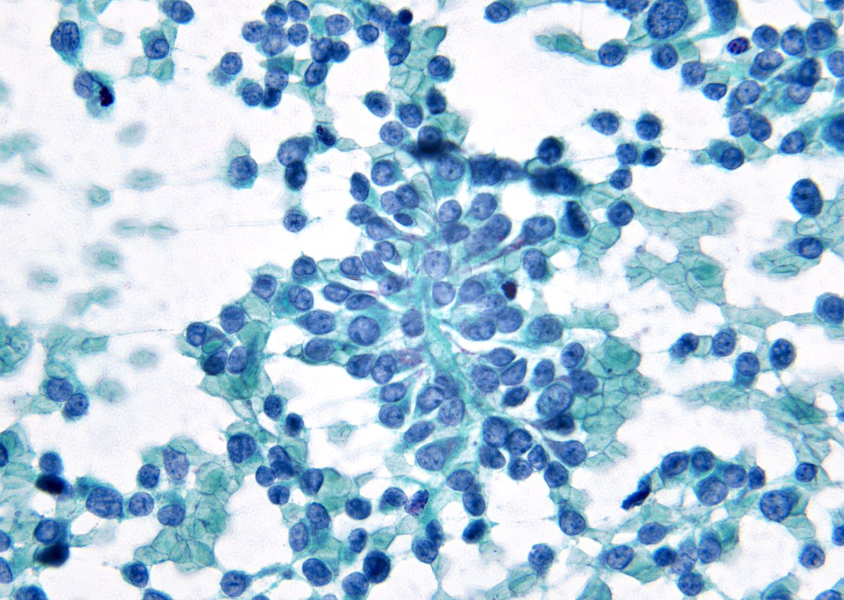 sza_jhcyto's tweet photo. If you think THYROID  Cytology is easy ...
Left - Medullary Carcinoma (MTC)
Right - Hurthle Cell Neoplasm (HCN) - Carcinoma on follow-up.
INCIs maybe helpful for an MTC dx,  as they are EXCEEDINGLY rare in HCNs (In fact, for many years I believed that you never see them in HCNs. https://t.co/48fbRNgRDf