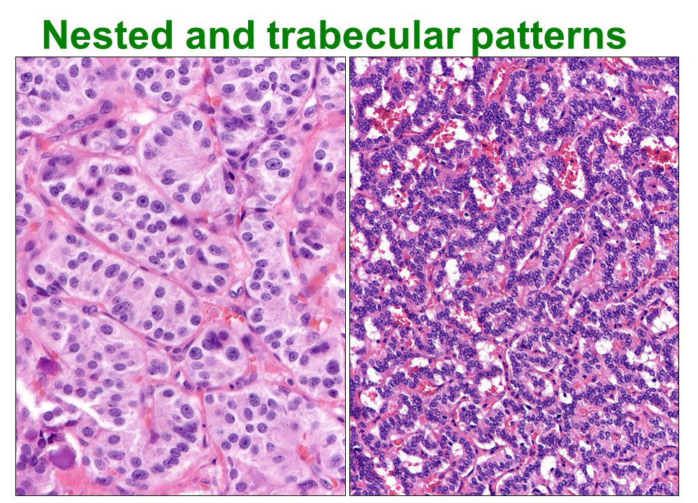 OlcaBasturk's tweet photo. 1/3 Pancreatic #neuroendocrine tumors may display various morphologic patterns that are
not only challenging diagnostically but appear to have biologic significance. Classical nested &amp; trabecular variants are shown here. #PanNET #neuroendocrine #PathTwitter https://t.co/aTeFVThvfX